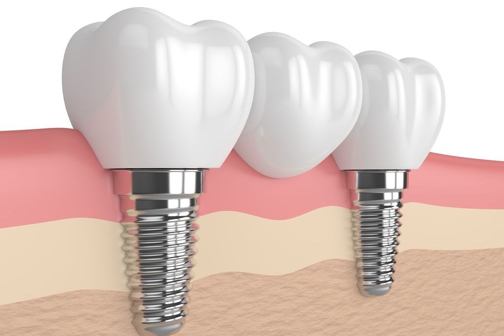 インプラントの注意点