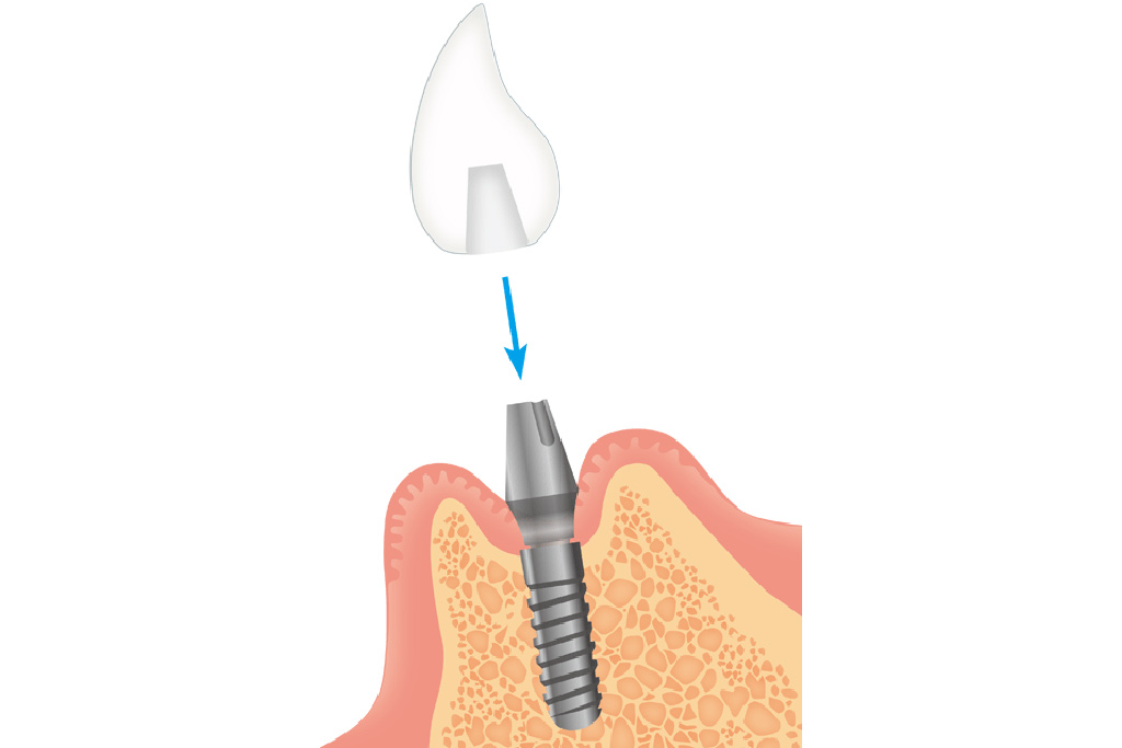 人工歯の型取りと仮歯の装着